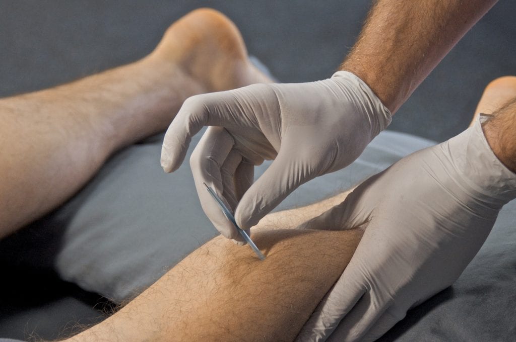 physical therapist performing dry needling technique on leg